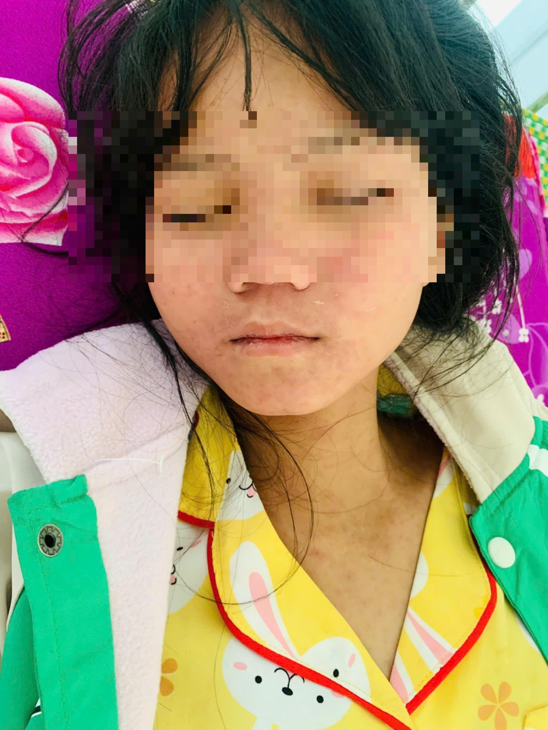 bung-phat-sot-phat-ban-o-tra-leng-1-1738812404.jpg
