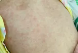 Bùng phát sốt phát ban nghi sởi, Sở Y tế Quảng Nam quyết không để lây lan
