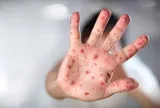 Cách chăm sóc trẻ bị tay chân miệng tại nhà hiệu quả mẹ cần biết