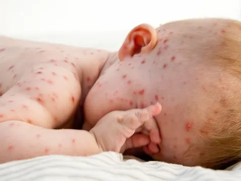 Bác sĩ Bệnh viện Nhi Trung ương giải đáp thắc mắc về tiêm vaccine phòng bệnh sởi