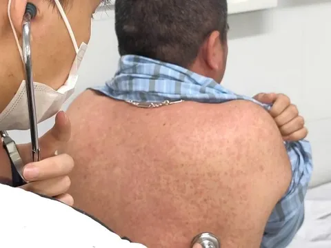 Người lớn mắc sởi: Nhiều ca bệnh diễn biến nặng, biến chứng nguy hiểm
