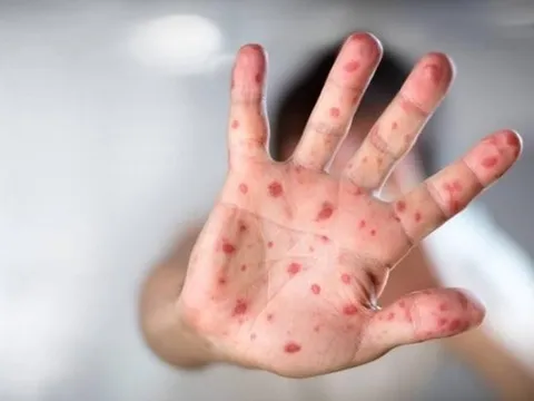 Cách chăm sóc trẻ bị tay chân miệng tại nhà hiệu quả mẹ cần biết